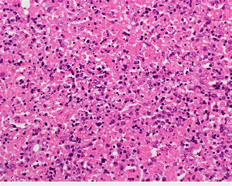 Lymph Node Biopsy Showed Areas Of Eosinophilic Necrotic Debris With