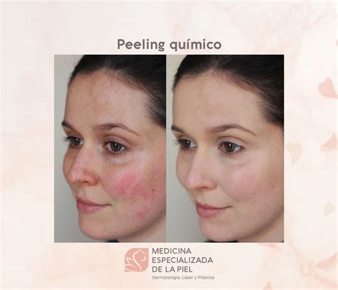 Peeling Quimico Medicina Especializada En La Piel