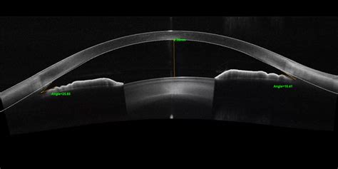 Optovue Solix Das Ultra High Speed Fullrange Oct Mit Oct