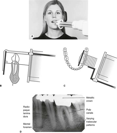 Anterior Periapical Radiograph