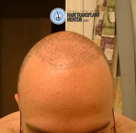 Hair Transplant Repair Update