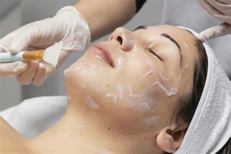 Tratamiento De Peeling Qu Mico En Alicante Lenas Beauty