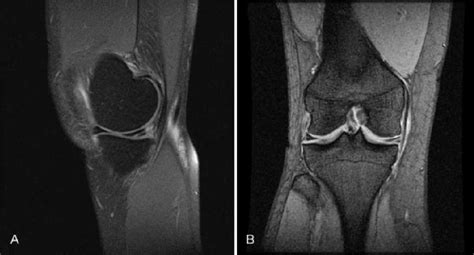 Grade 3 Signal Hyperintensity In The Medial Meniscus A T2 Sagittal