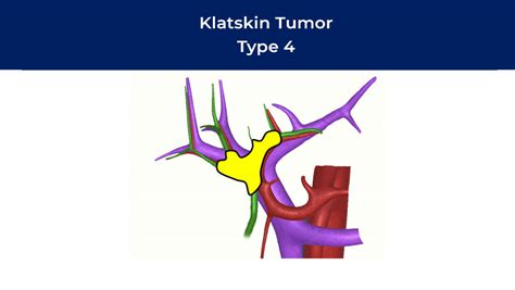 Klatskin T M R Kolanjiyokarsinom Safra Yolu Kanseri