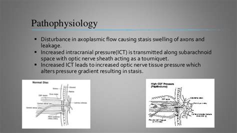 Papilledema Dr Shylesh Dabke