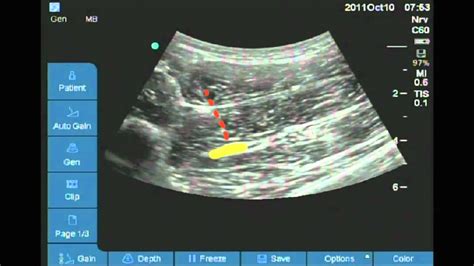 Sciatic Nerve Block Ultrasound