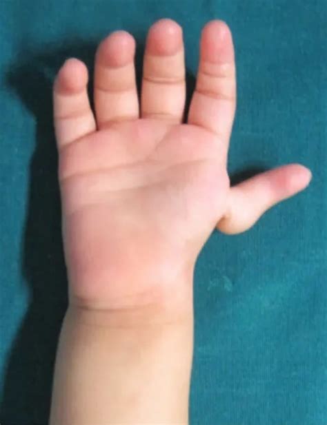 Thumb Hypoplasia Causes Classification Diagnosis Treatment