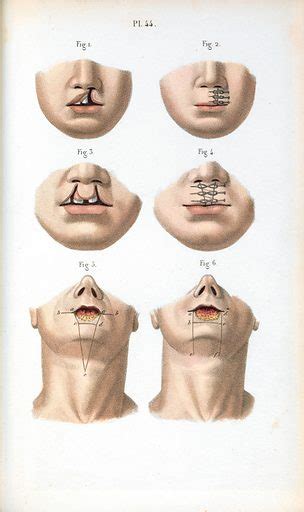 Cheiloplasty Surgical Techniques For Repairing Various Types Free