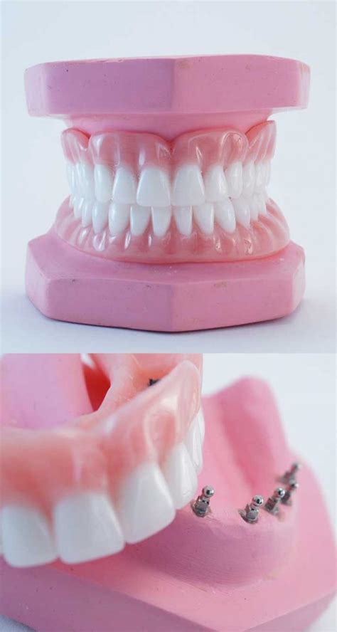 Why are Snap in Dentures so good? - Snap In Dentures