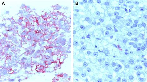 Cd117 C Kit Expression In Human Hepatocellular Carcinoma Clinical Oncology