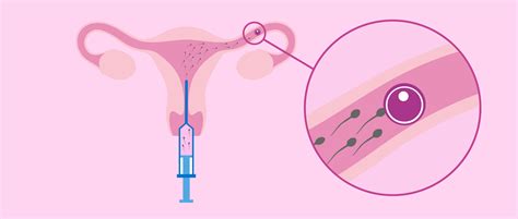 Qué es la inseminación artificial intrauterina