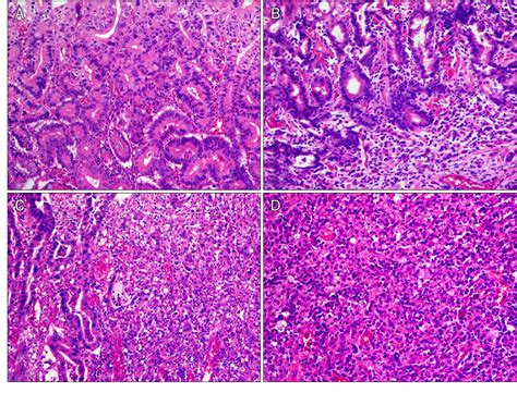 Figure 1 From Histologic Discrepancy Between Gastric Biopsy And