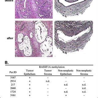 RASSF1A Methylation In Microdissected Cells A Tumor And Nonneoplastic