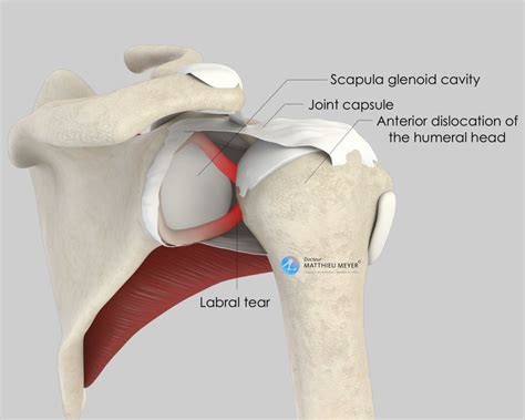 Arthroscopic Capsulolabral Repair (Bankart Procedure) - Doctor Matthieu Meyer