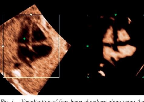 3d Ultrasound Of The Heart