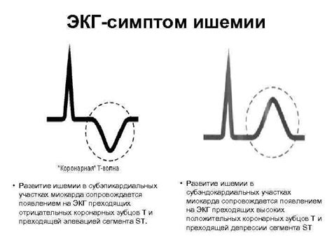 Описание экг при ибс стенокардии с описанием - фото презентация