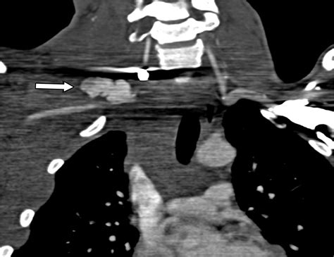 Subclavian Artery Anatomic Review And Imaging Evaluation Of Abnormalities Radiographics