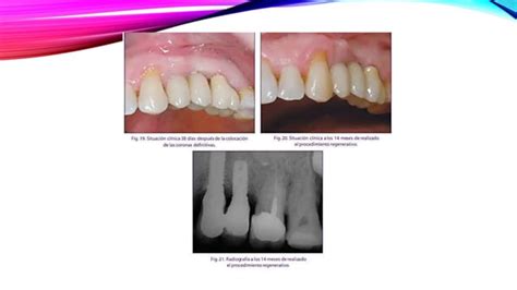 Regeneración ósea guiada en implantes pptx