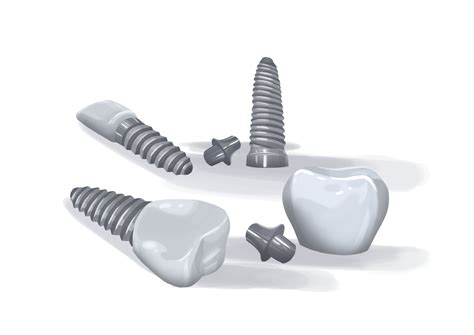 Dental implant failure: rate, symptoms, and causes | Authority Dental