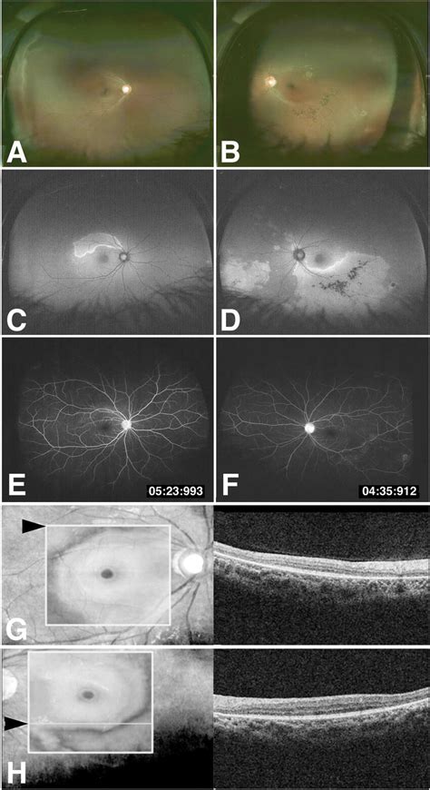 Wide Field Fundus Photography A Right Eye Retinal Pigment Epithelium