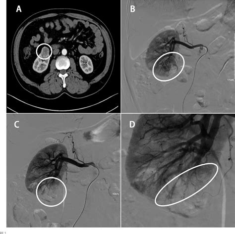 Figure From Clinical Application Of Superselective Transarterial