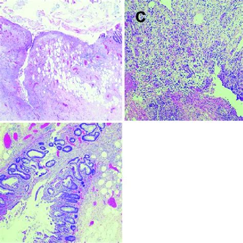 Histological Analysis Of Excised Specimen A Hande Stain ×40