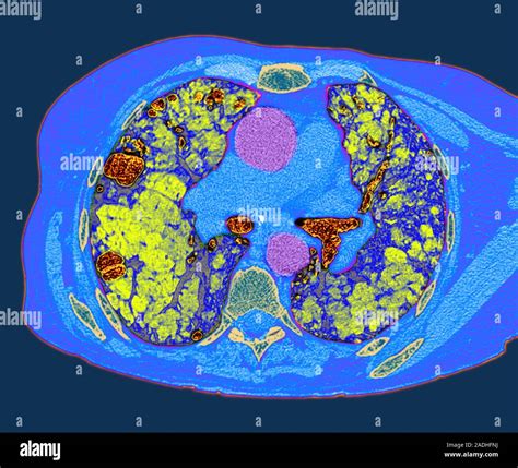 Lung Fibrosis Image 3 Of 3 Sequence Of Ct Scans Of A Patient With Lung Pulmonary Fibrosis