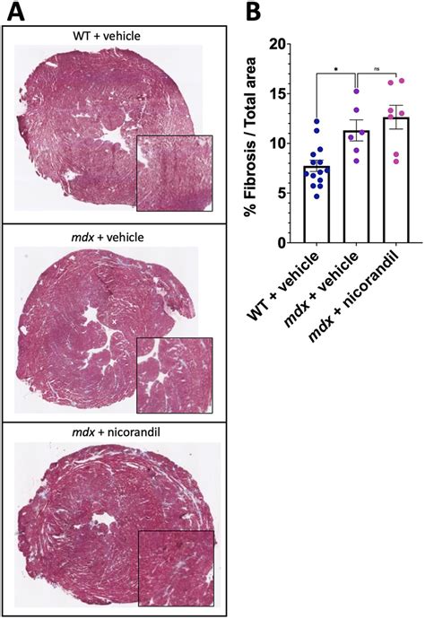 Nicorandil Does Not Decrease Cardiac Fibrosis In Month Aged Mdx