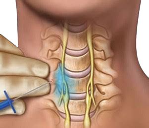 Stellate Ganglion Block FAQ Ashmore Osteopathic GroupAshmore