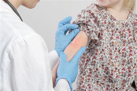 Assessing Atopic Dermatitis Severity In Clinical Practice Dermatology Advisor