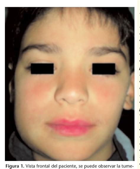 Figure 1 From Fibroma Osificante De Mandibula Presentacion De Un Caso Semantic Scholar