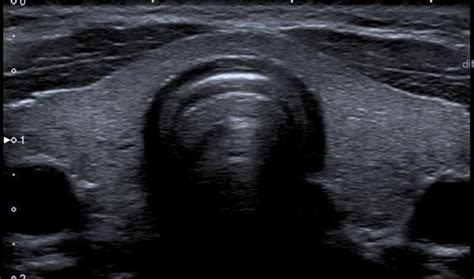 Thyroid Ultrasound Sonographic Tendencies