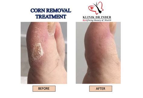 Corn Removal - Laser Treatment - Aesthetic Clinic- Klinik Dr Inder