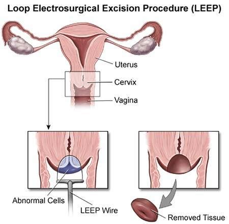 abnormal pap smear colposcopy