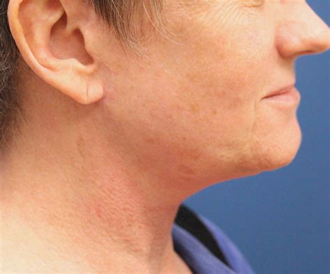 Fractional Laser Resurfacing Case 7 Cascade Facial Surgery And