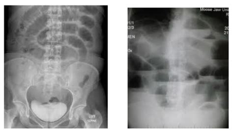 Bowel Obstruction Flashcards Quizlet