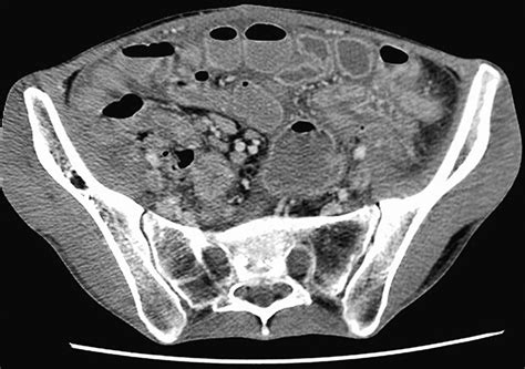 Unexplained Gastrointestinal Dysmotility The Clue May Lie In The Brain