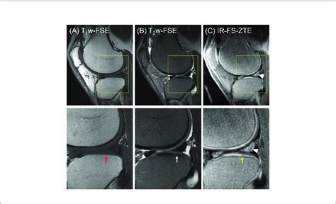 A Patient With Oa 56 Year Old Male A T 1 W Fse B T 2 W Fse