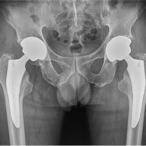 Plain Radiograph Of Pelvis Months After Right Hip Arthroplasty