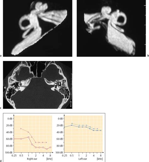 Tumors Of The Middle Ear And Temporal Bone Ento Key