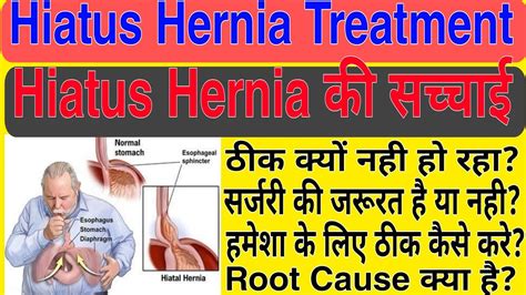 Hiatus Hernia Treatment. Hiatus Hernia क्या है? - YouTube