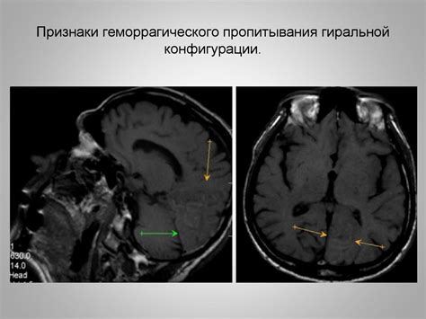 МРТ в диагностики ишемического инсульта. Сосудистая патология. Лекция 3 ...