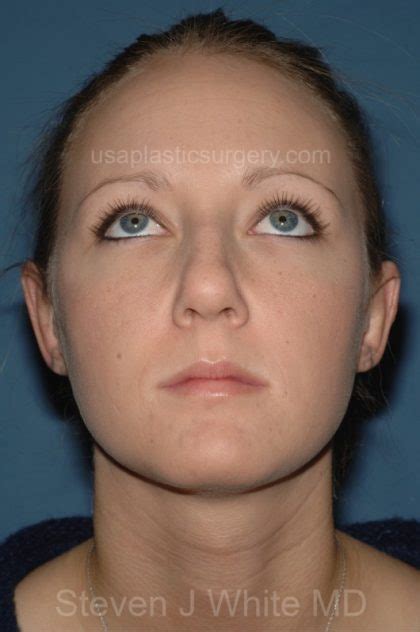 Patient 3280 Ear Pinning Otoplasty Before And After Photos Dallas