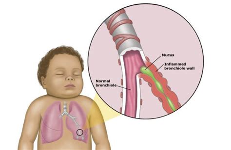 Saiba Mais Sobre A Bronquiolite Blog Pulmolab