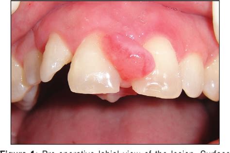 Figure 1 From Diode Laser For Excisional Biopsy Of Peripheral Ossifying