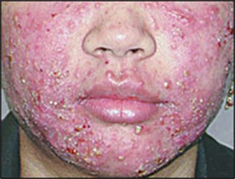 Tetracycline Acne