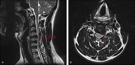 Cervical Radiculopathy Spine Orthobullets, 47% OFF