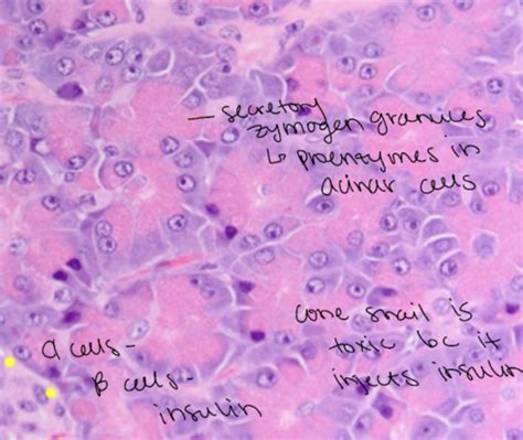 Lec Endocrine Pancreas Pathology Flashcards Quizlet