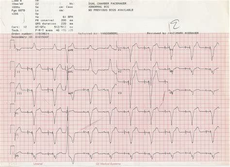 Abnormal Ekg Heart Blocks