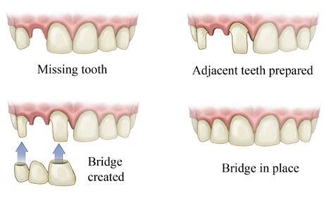 Dental Bridge Explained Dental Implant Surgery Teeth Implants Implant